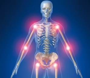 VISUEL ARTHROSE(1)